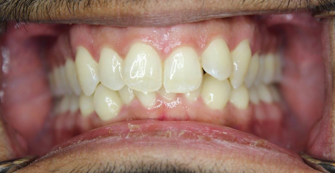 porcelain veneers before