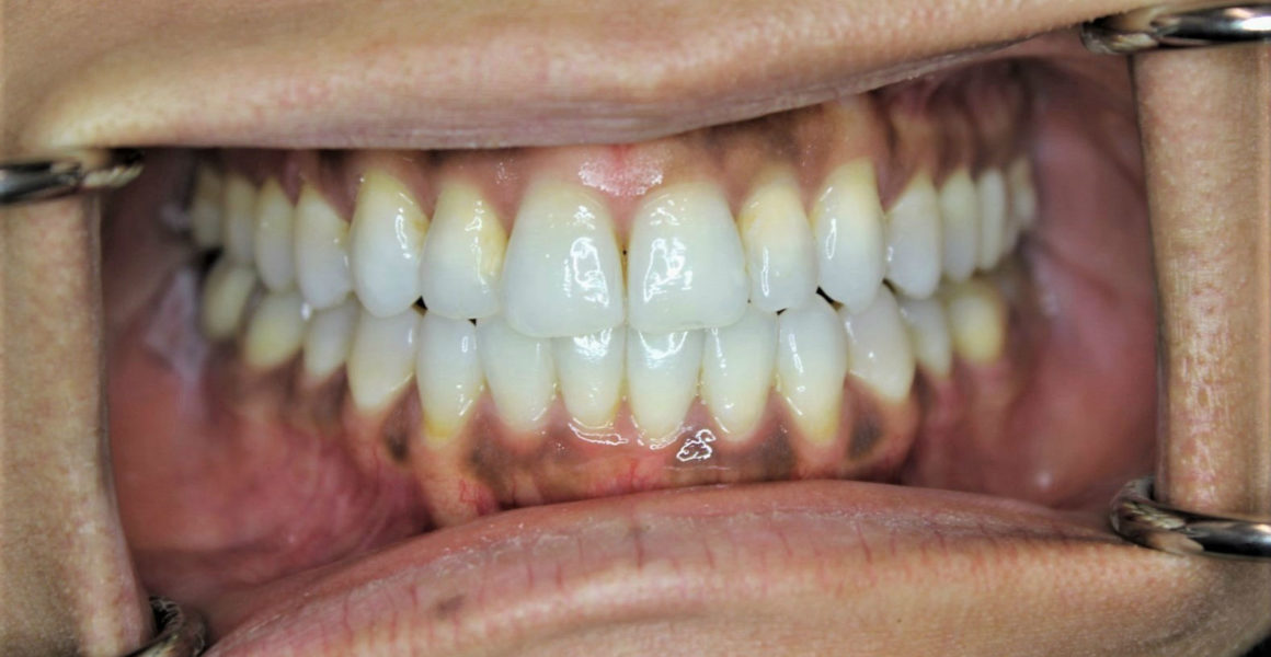 invisalign crowding after