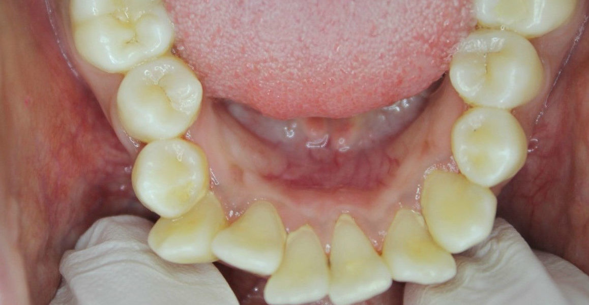 invisalign crowding before