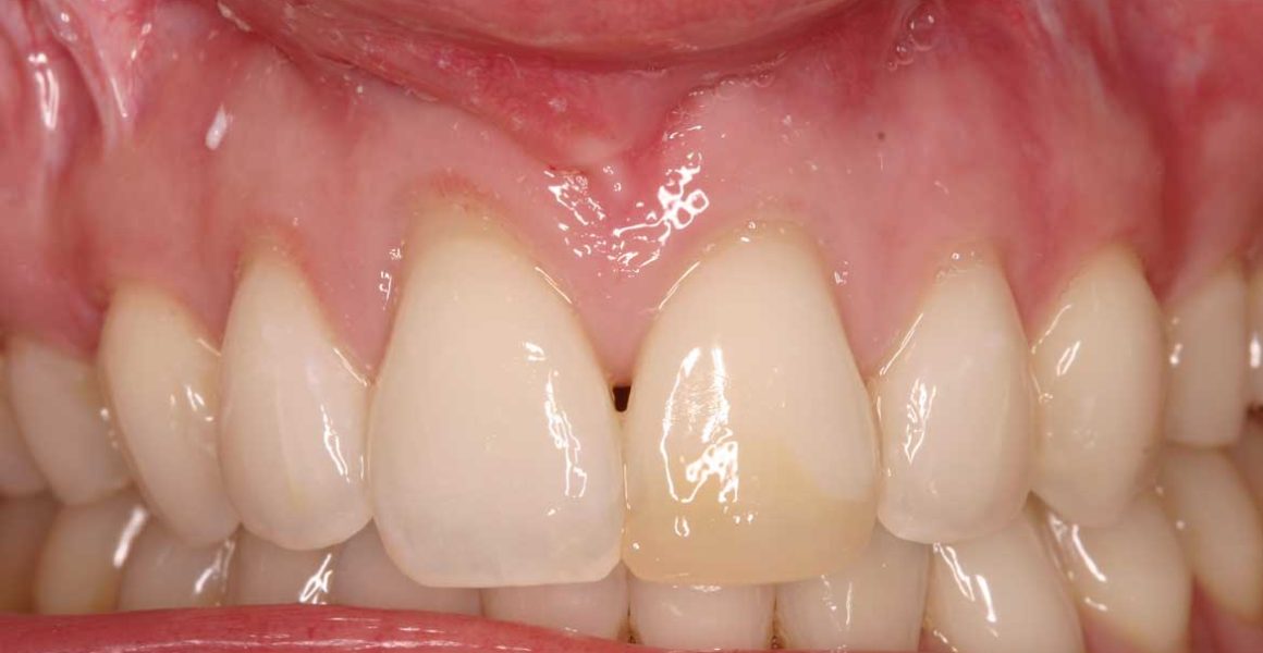 porcelain veneers before