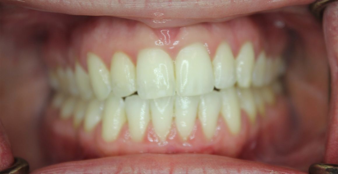invisalign after