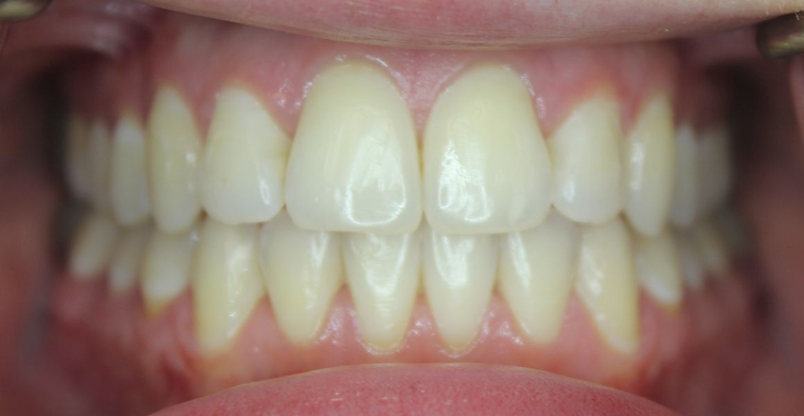 invisalign after
