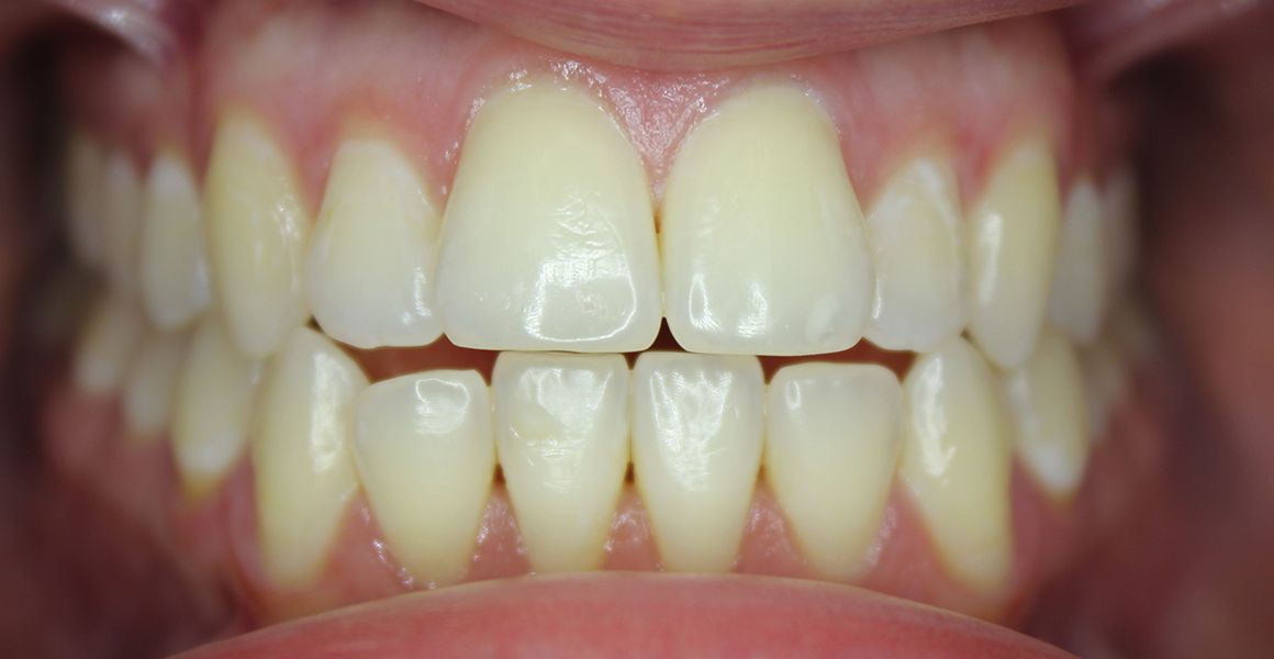 invisalign before