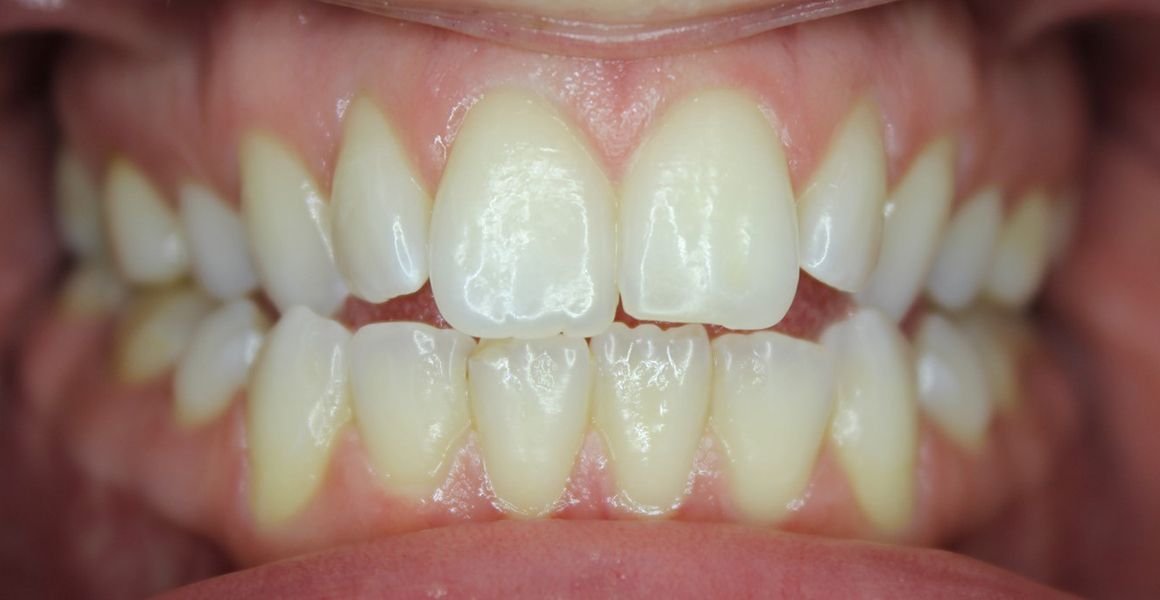 invisalign before