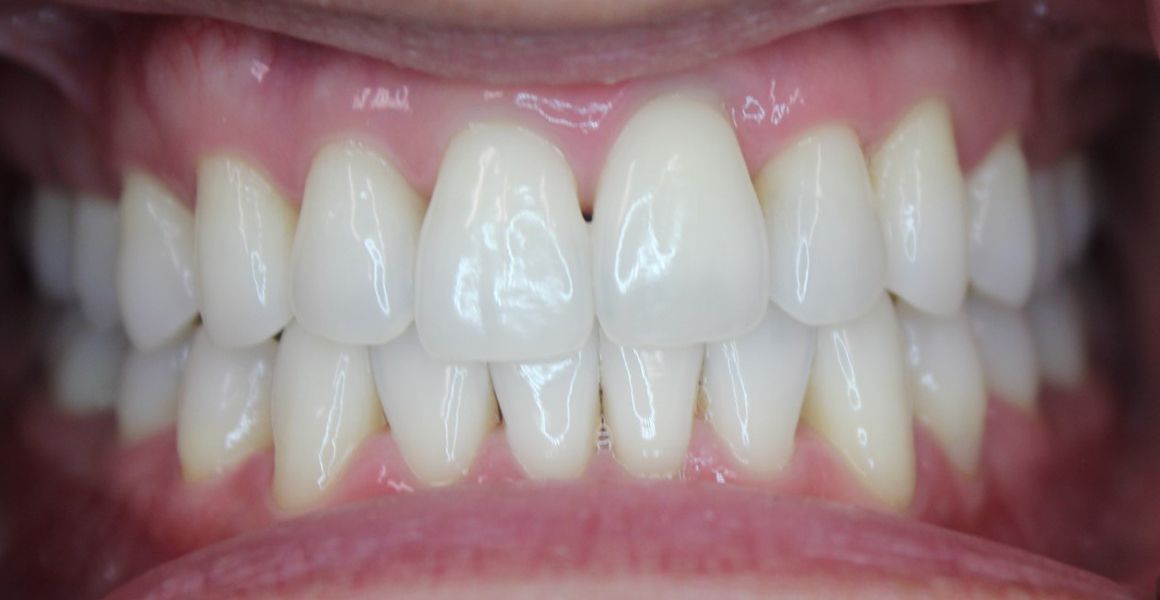 invisalign after