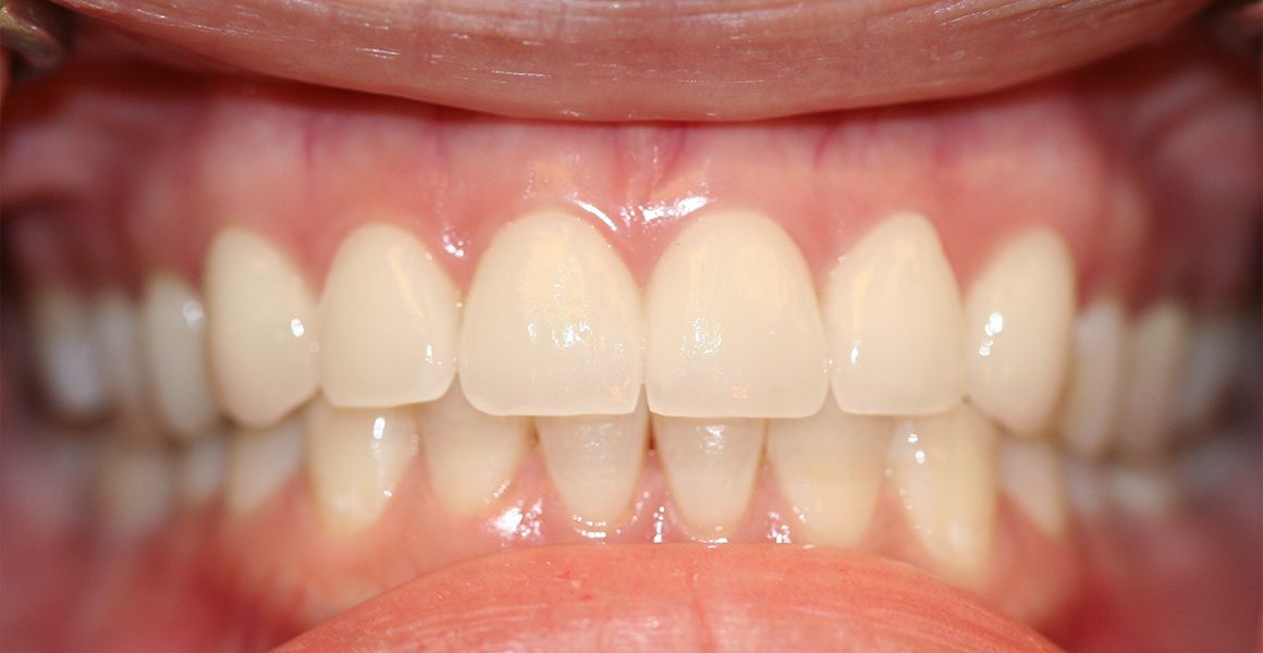 porcelain veneers after