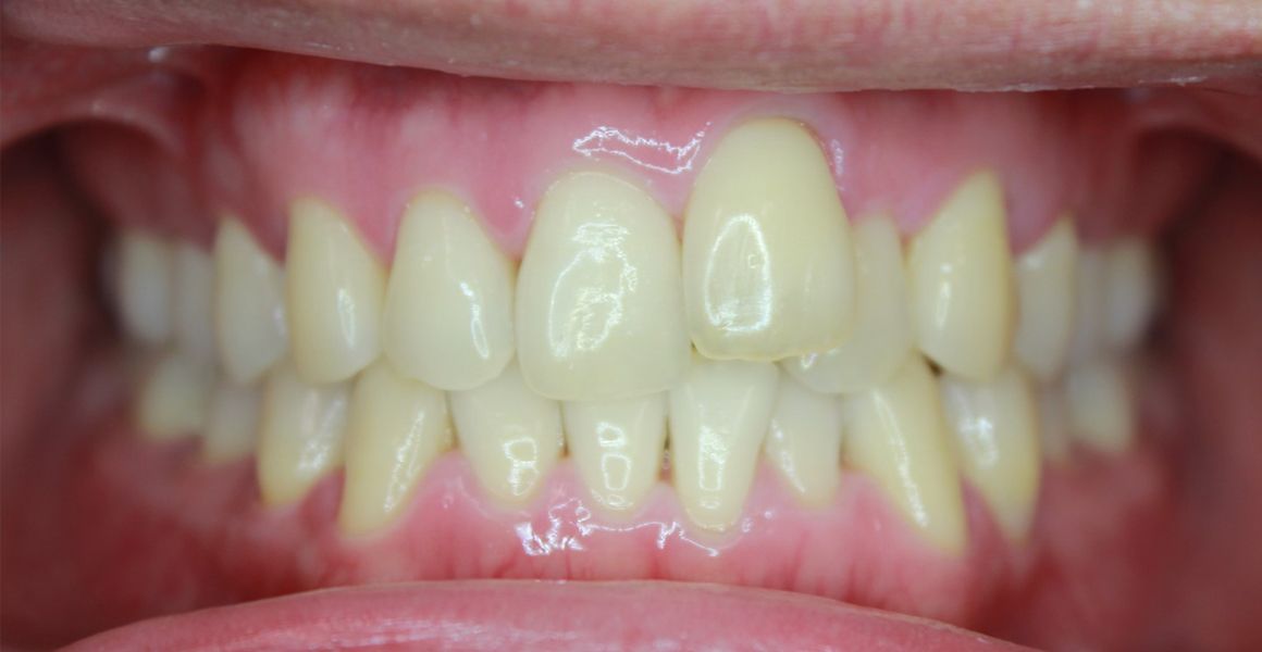 teeth whitening before