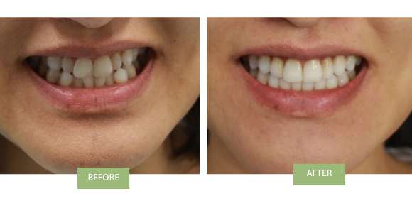 Invisalign for crowded teeth