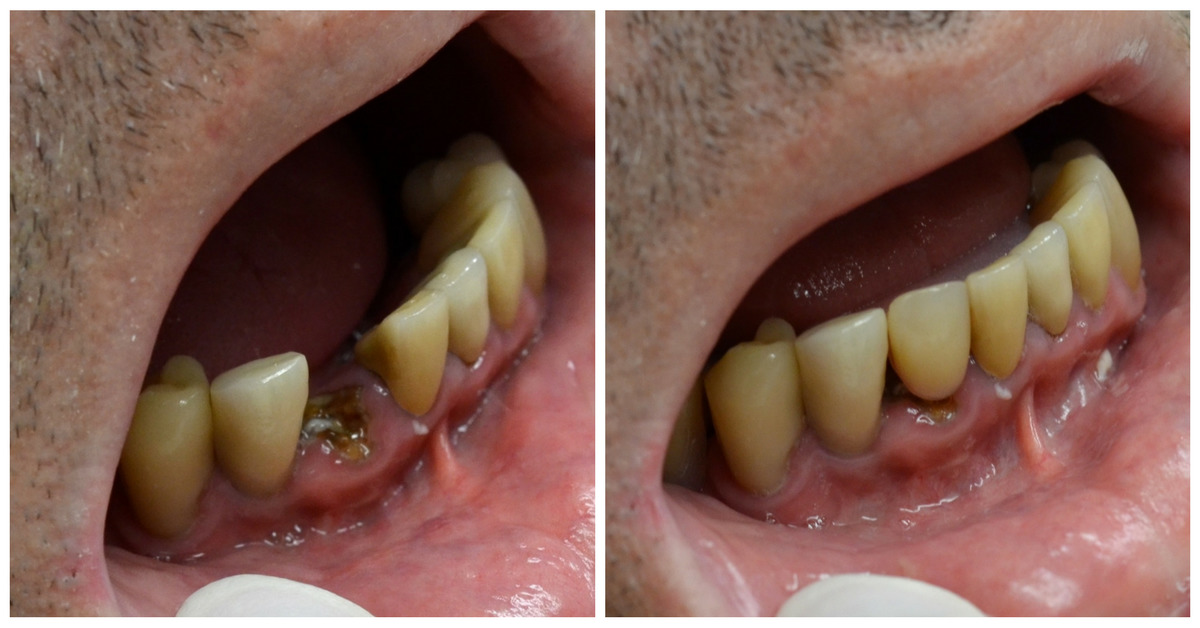 same day dental implants