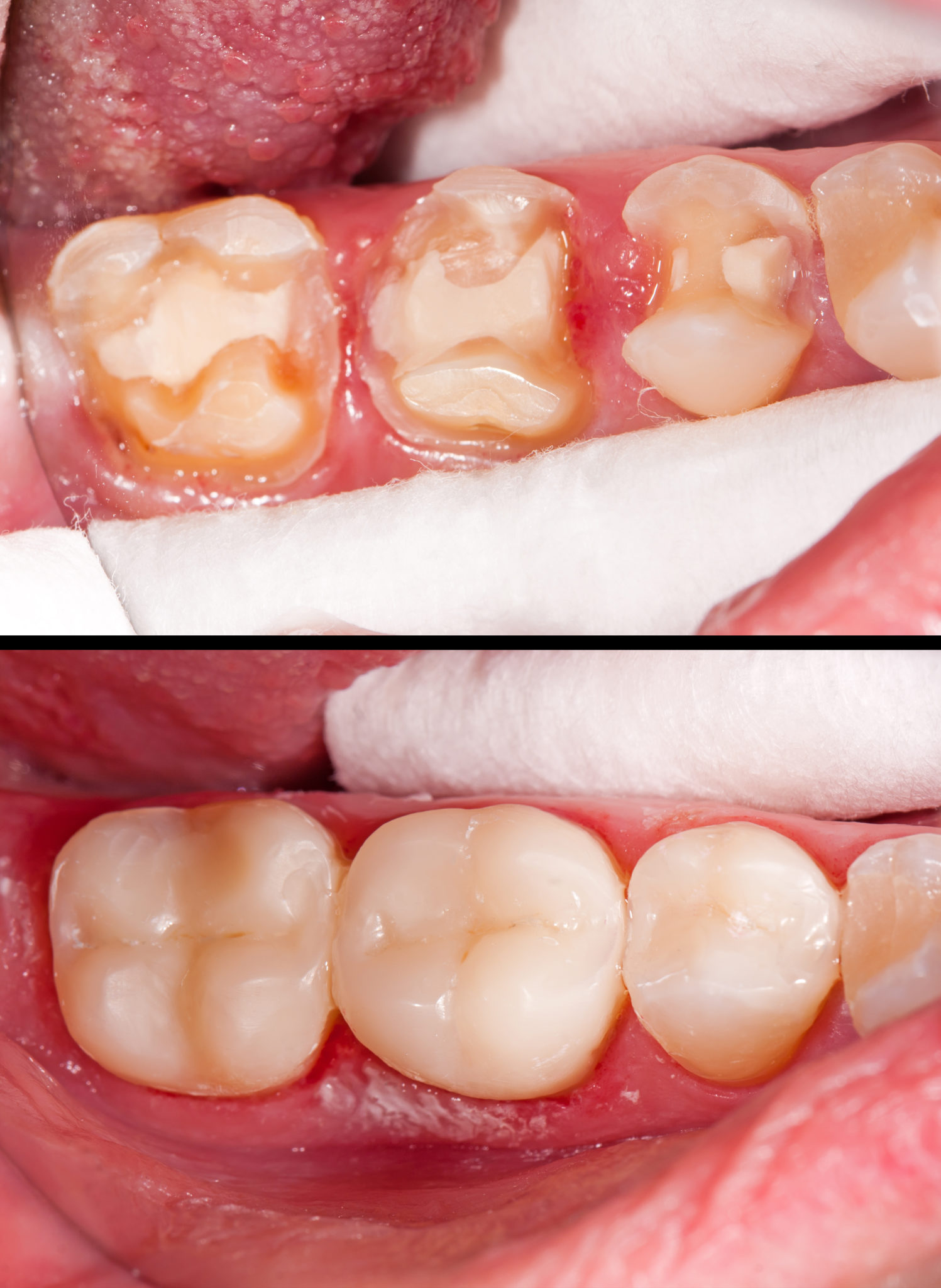 Porcelain & Composite Fillings NYC 172 NYC Dental