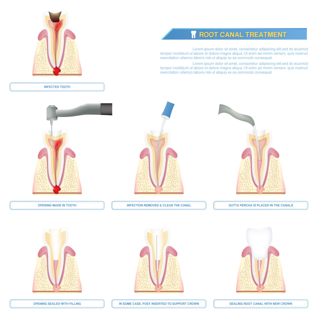 root canal treatment stages