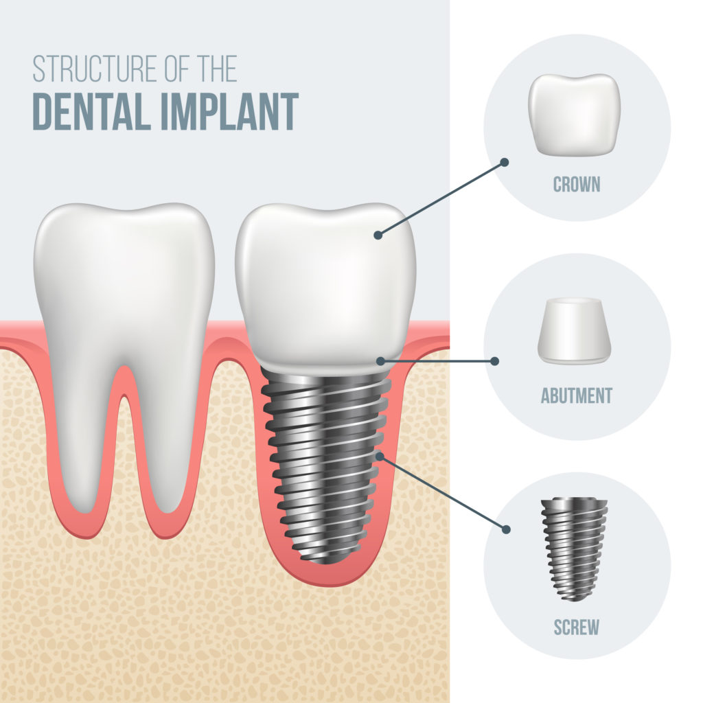 Dental implant with abutment and crown