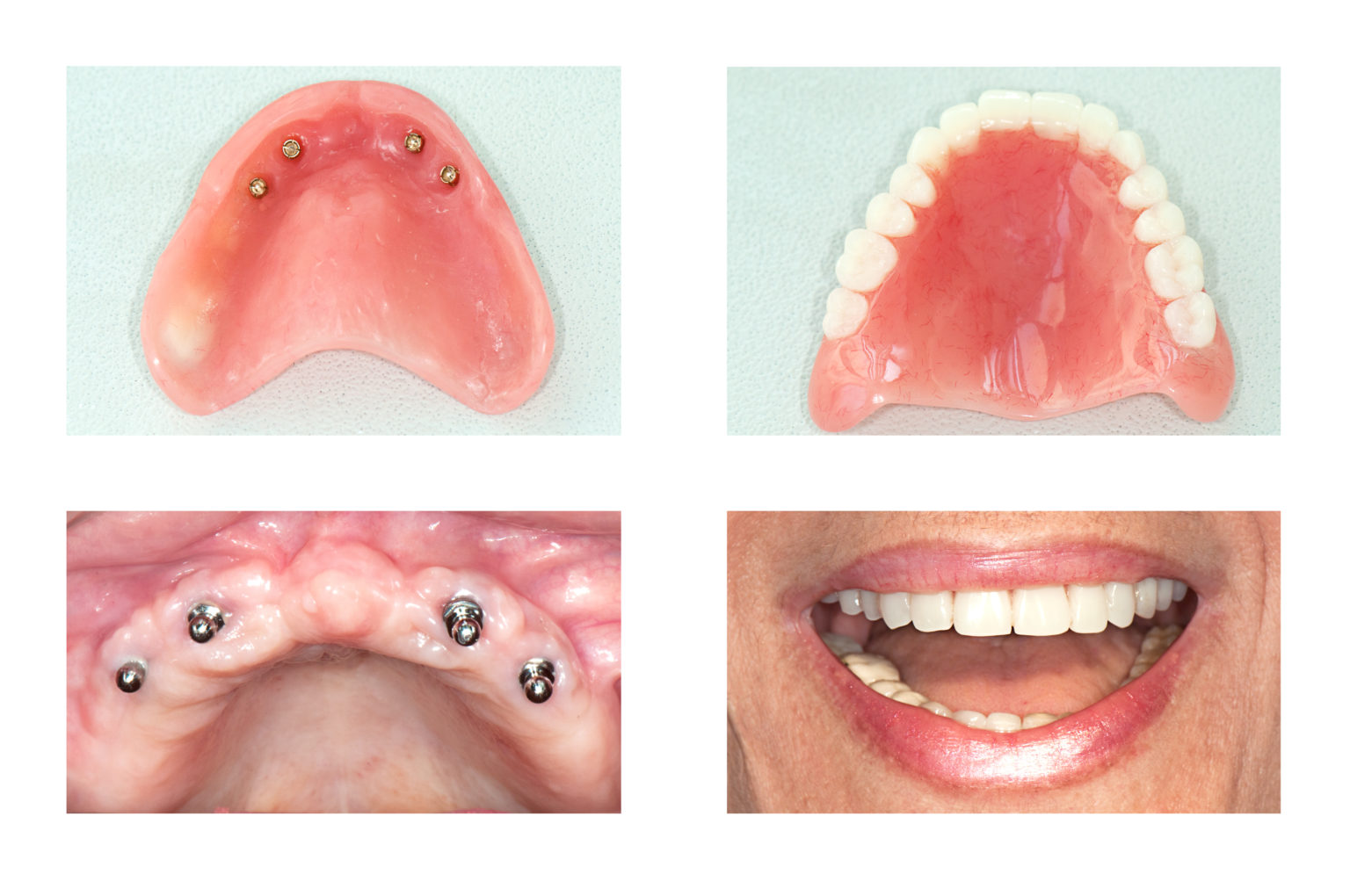 All On 4 Dental Implants NYC - Cost of Implant Dentures ...