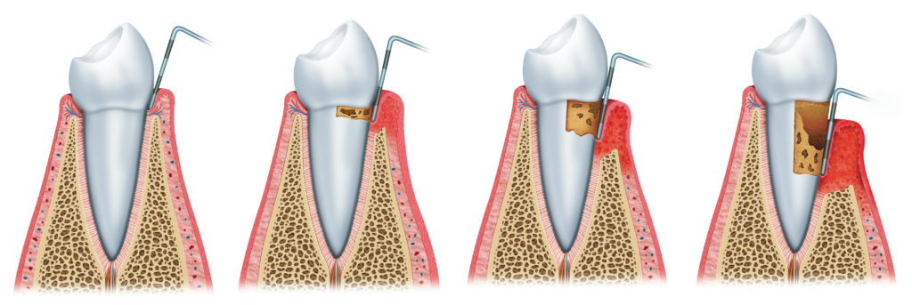 development of periodontal pocket 
