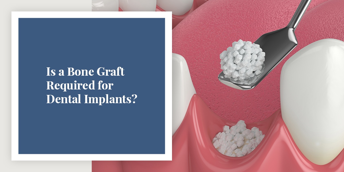 Is a Bone Graft Required for Dental Implants?