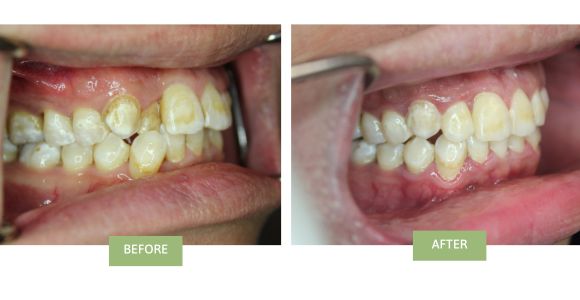 Cross Bite Before and after