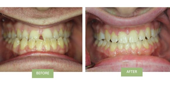 Invisalign for Gap in front teeth Before and After photos