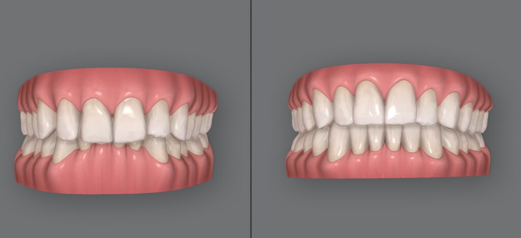 Invisalign for overbite before and after simulation