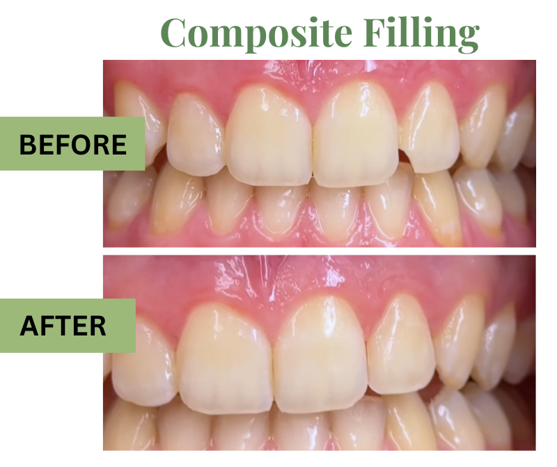 same day tooth repair with composite filling
