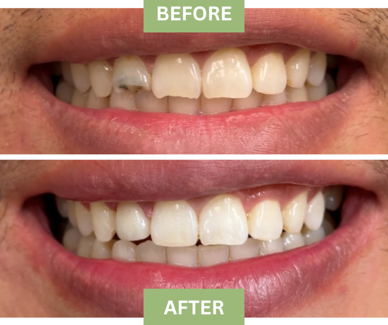 tooth repair with dental crown