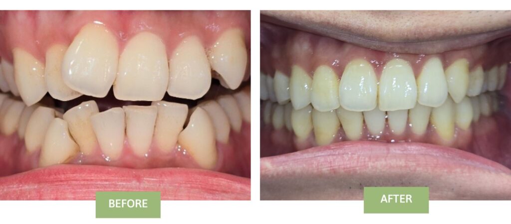 Invisalign Before and after - 172 NYC Dental - Dr Sang Hoon Ahn - Diamond Plus Invisalign Dentist