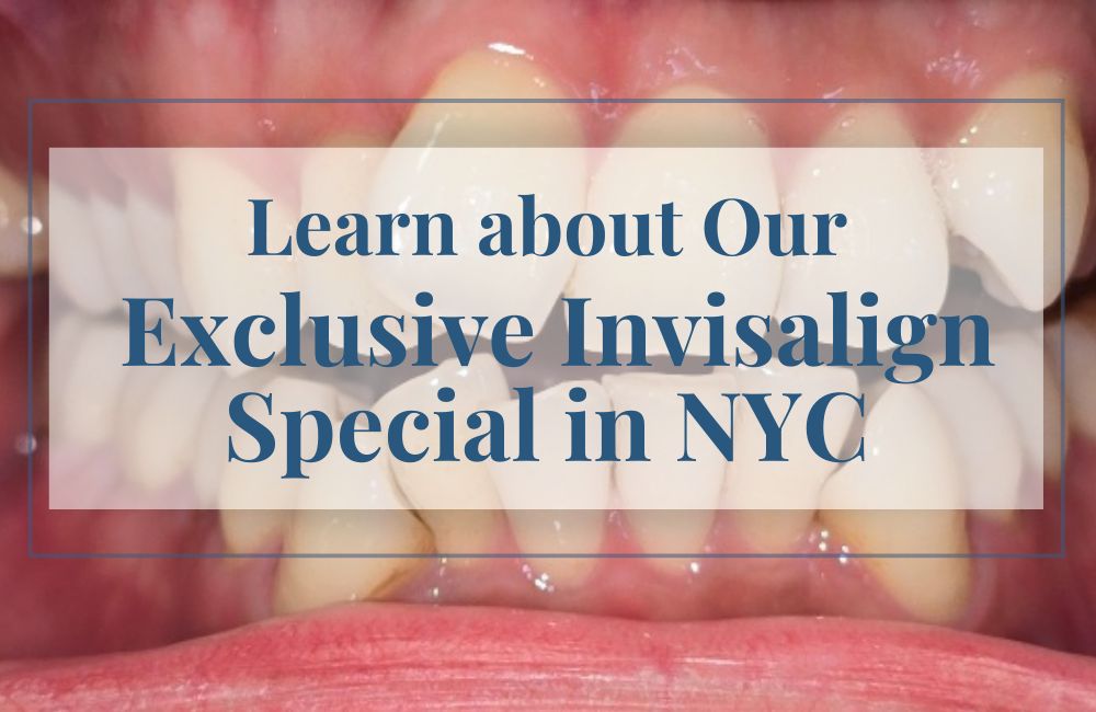 Invisalign Discounts & Invisalign Special @ 172 NYC Dental